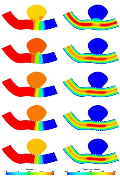 Figure 10. Sequence of pressure (left), velocity (right) solution contours. From top to bottom:unstented vessel, wire �=0.6 mm, 0.7 mm, 0.8 mm, and 0.9 mm, respectively.
