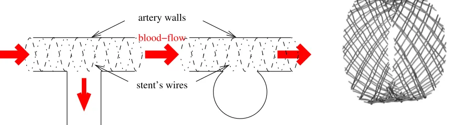 Figure 1. A sketch of stented arteries: with a collateral artery (left), an aneurysmal sac(middle) and a 3D example of a real metallic multi-wired stent (right)