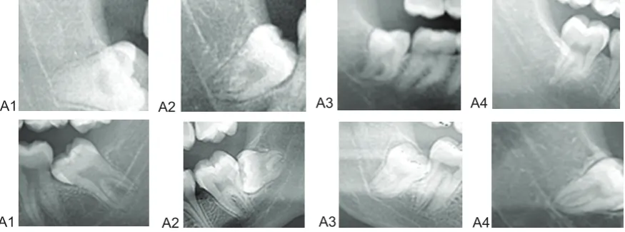 Figure 1: the relative relationship and proximity of the mandibular 3rd molar roots to         the inferior alveolar canal