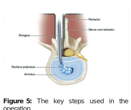Figure 5: The key steps used in the           operation.  