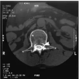 Figure 3AAxial computerized tomography scan withcontrast at L1 level, demonstrating lack of thecal sacindentation and preservation of L2 nerve root within the canal(arrowhead).