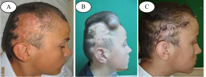 Figure 1: A- Postburn alopecia B-Crescent expander under the normal scalp, C-Expander removal, scar excision and complete scalp reconstruction 