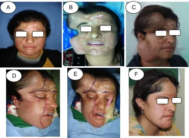 Figure 2: A- Postburn scar of forehead with two expanders inserted on either side of the scar, B- The expanders removed, the scar excised, C- Forehead reconstruction, D- Result after scar maturation, E- Right eye brow reconstruction with hair graft