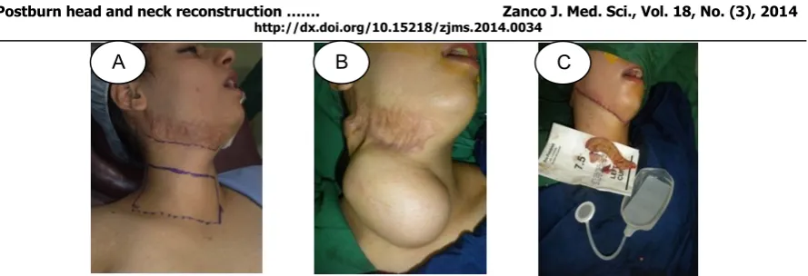 Figure 4: A- Post burn scar of upper neck, marking for expander insertion, B- Tissue         expansion completed, C- Expander removal, scar excision, and neck reconstruction