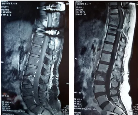 Figure 3. Plain X-ray anteroposterior and lateral views after surgical decompression and fixation  