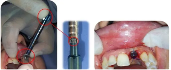 Figure 1A: Unrestorable tooth removed.  Implant bed prepared in palatal direction. Implant placed in the prepared bed