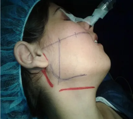 Figure 1: Surface land marking of the an-terior border of the parotid gland 