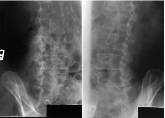 Figure 3Lumbar spine obliques views.