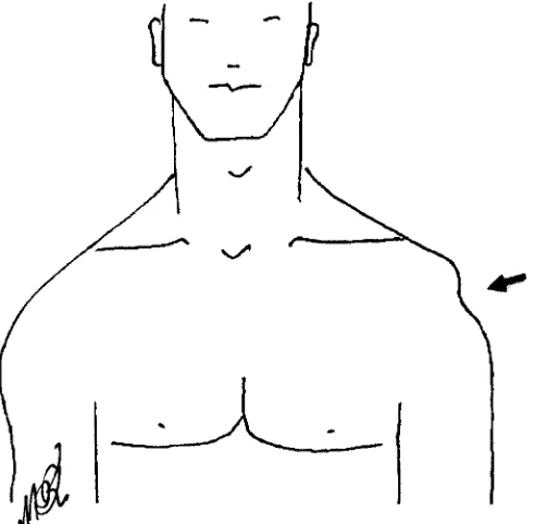 Figure 2Sulcus sign (arrow)
