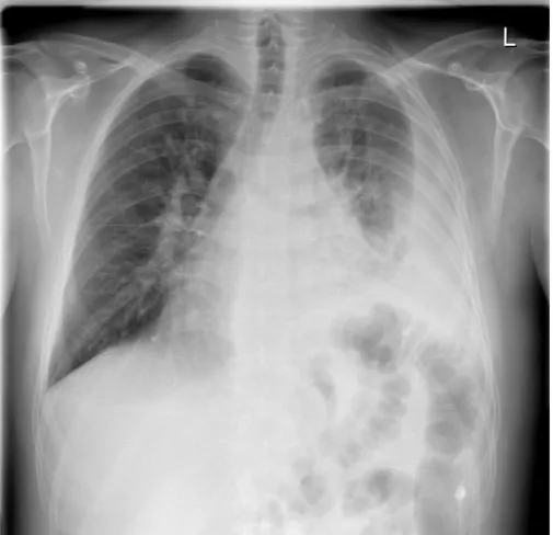 Figure 1 A chest radiogram showing large left pleural effusion