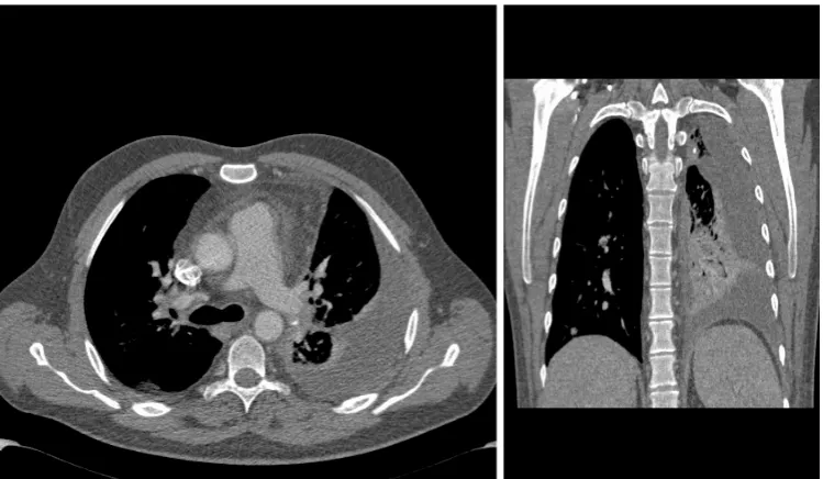 Figure 2 Axial computed tomography (CT) scan (left) and coronal reformatted CT image (right) of the chest showing left pleural effusion