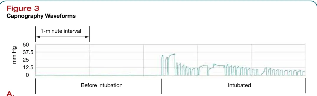 Figure 3Capnography Waveforms