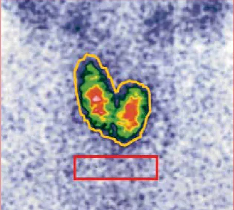 Figure 1 a: Irregular region of interest drawn around the thyroid gland (yellow) and rectangular background region of interest under the thyroid gland (red)