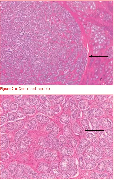 Figure 2 a: Sertoli cell nodule