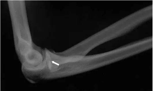 Figure 1Lateral radiograph of the right elbow. (Arrow: cortical disruption of the superior aspect of the radial head)
