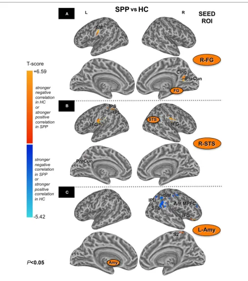 FIGURE 2 | Brain areas with stronger negative correlations in HC or with stronger positive correlation in SPP (red) and brain areas with stronger negative correlations in SPP or with stronger positive correlations in HC (blue) (unpaired t-test; uncorrected