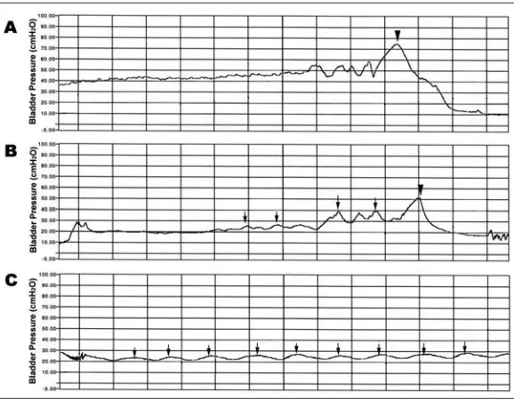 Table 1: Initial cystometric results after postpartum 