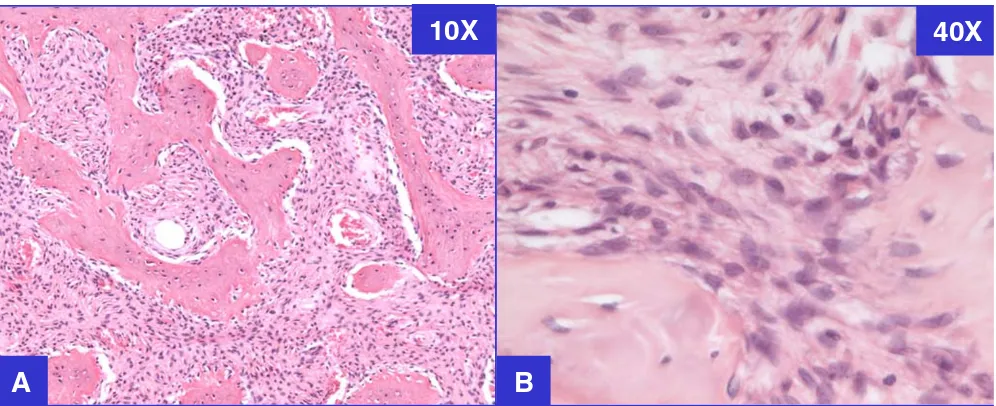 Figure 1Fibrous dysplasia with classical patternFibrous dysplasia with classical pattern