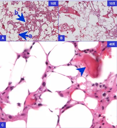Figure 2Fibrous dysplasia with fatty metamorphosisadipocytes interspersed between the fibroblastic stroma cells