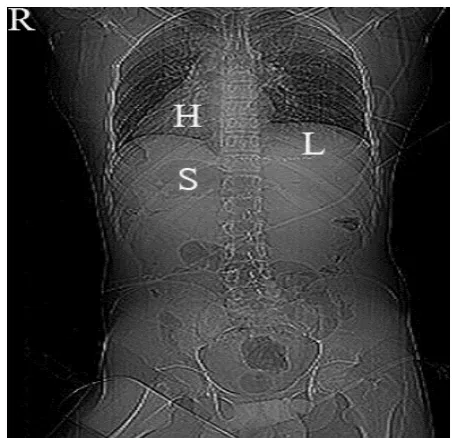 Figure 4. AP tomogram of the chest, abdomen and 