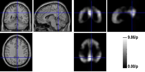 Figure 3: Voxel/Variable weights. (Left) Magnetic Resonance Image which shows the brain anatomy; (Right) The image with the final weights for each voxel (or each variable)