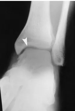 Figure 1Initial x-rays upon presentation: A bony defectwithout a distinct outline on the medial aspect of the left talardome (arrowhead) possibly with an associated bony fragmentand soft tissue swelling is seen.