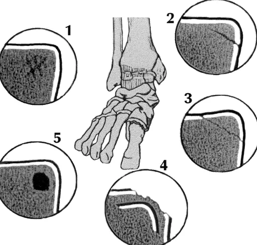 Figure 3Loomer’s revision of the Berndt and Harty Classification System I. Compression, II