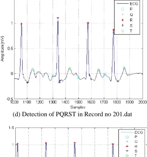 Table 4. Detection of Accuracy for Different Type of Arrhythmia on MIT-BIH Arrhythmia Database  