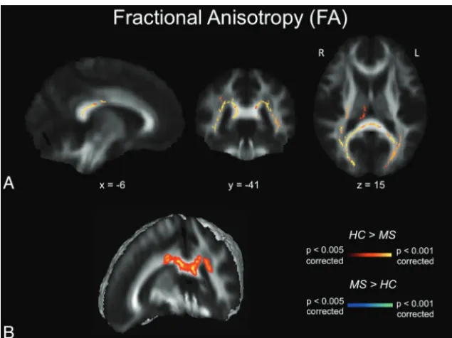 FIG 1. FA maps.been thresholded atisons).white matter clusters between the 2 groups. Note that the results are thickened for visualparison HC A, TBSS FA results for healthy subjects compared with patients with MS
