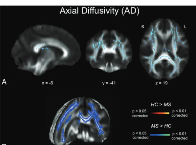 FIG 2.MD maps.comparisons) different white matter clusters between the 2 groups. Note that the results arethickened for visual purposes only