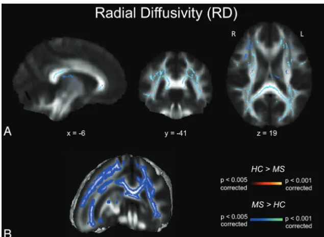 FIG 4.RD maps.been thresholded atisons).white matter clusters between the 2 groups. Note that the results are thickened for visualparison HC A, TBSS RD results for healthy subjects compared with patients with MS.Signiﬁcant clusters of increased RD values i
