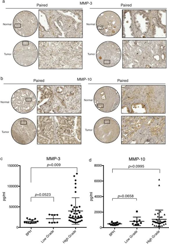 Figure 3.  Detection of MMP-3 and -10 expression in clinical specimens of prostate cancer patients