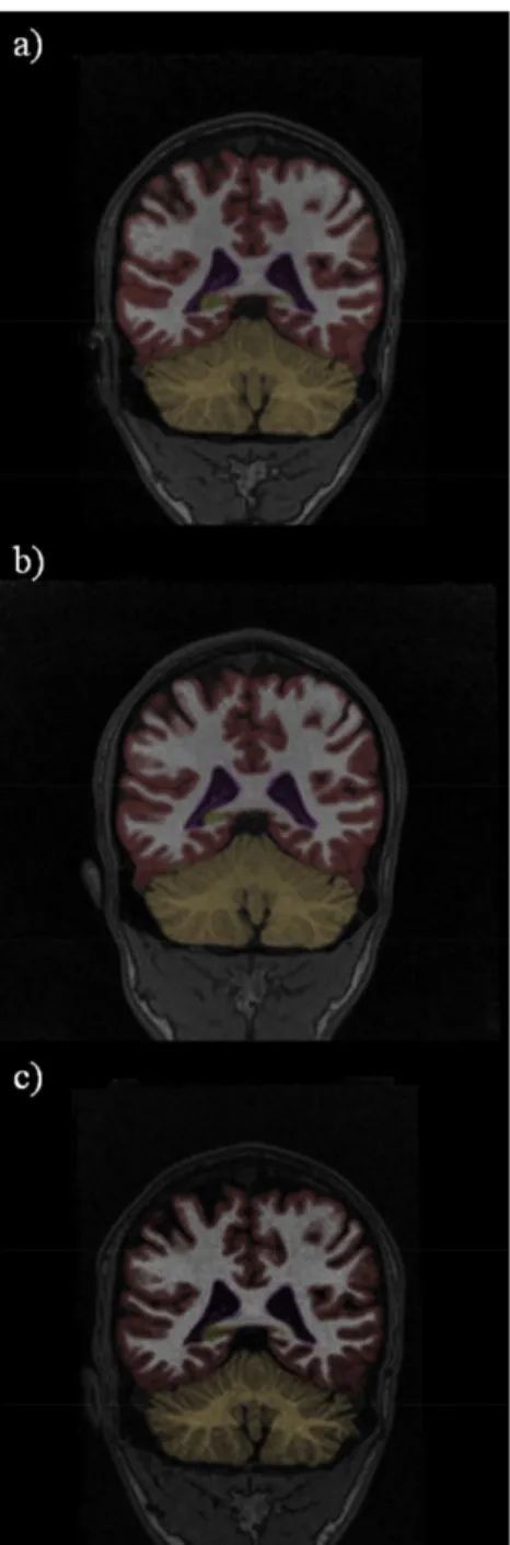 Fig. 2. Successful NeuroQuant segmentation of repeated MRIs obtained in a 21-year-old patient with moderate traumatic brain injury at a) 9 days postinjury and b) 3 months and c) 12 months postinjury.