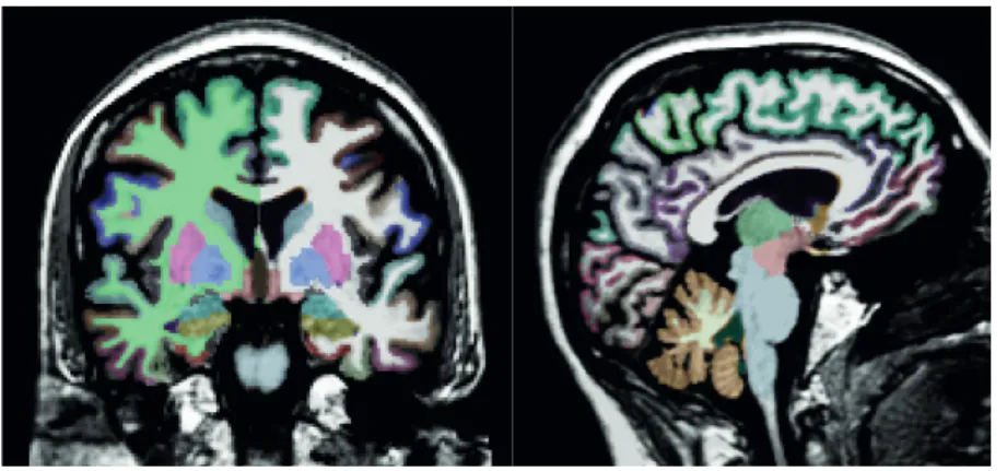 Fig. 3. Segmentation of subcortical structure volumes using the FreeSurfer software (Appendix 3)