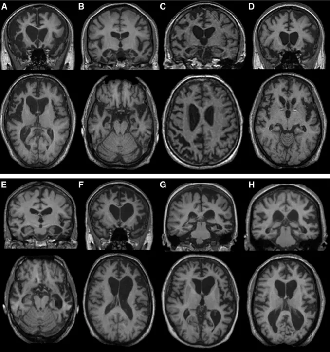 Fig. 2. Examples of structural MR imaging in pathologically-conﬁrmed frontotemporal dementia syndromes