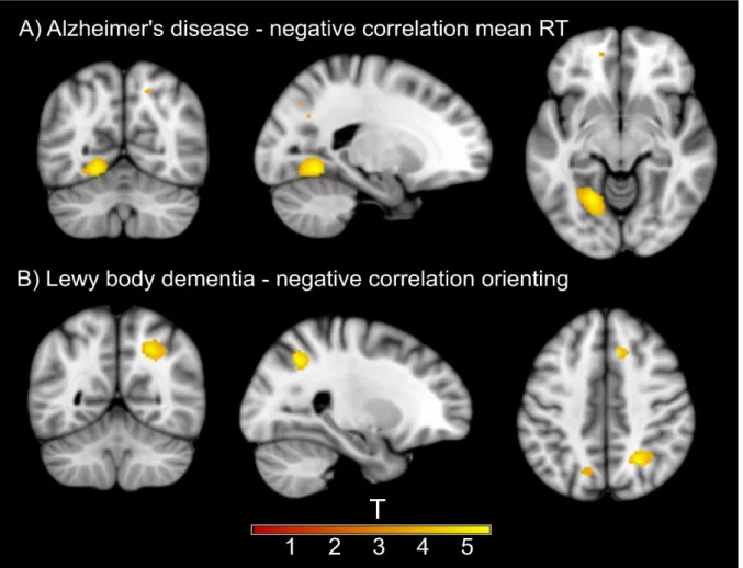 Figure 2.4. Significant clusters from VBM analysis. A) Negative correlation between mean  reaction time (RT) and grey matter volume at the left lingual gyrus in the AD group