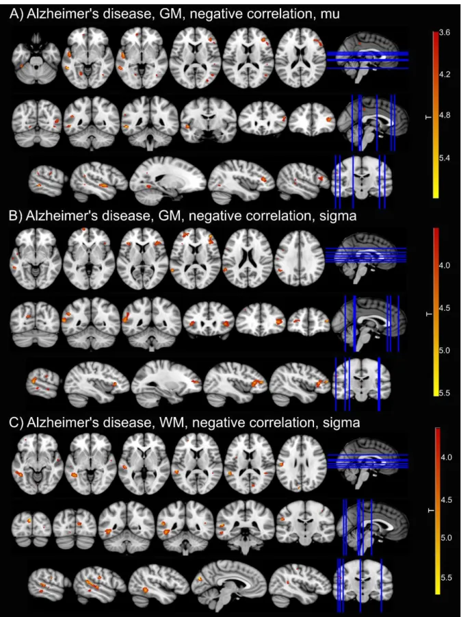 Figure 3.4. Correlations between ex-Gaussian parameters and grey matter (GM) and white  matter (WM) volume in AD