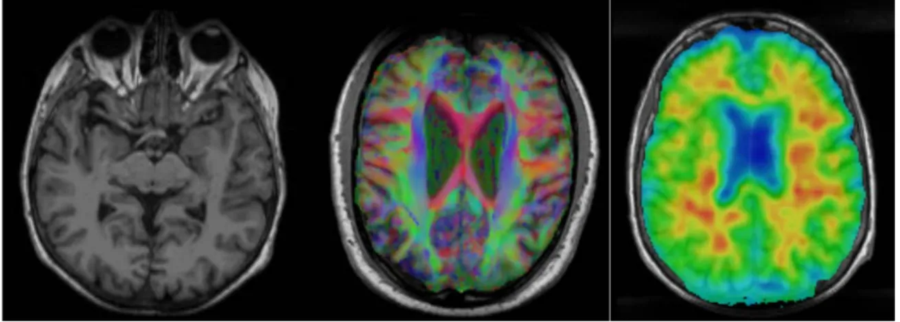 Figure 3-9: Image shows MRI, DTI and PET cross sections,  as shown by the Papaya viewer
