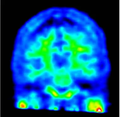 Figure 4-10: PET Shown in the Papaya Viewer without Correcting   for extrema values Inside the Brain
