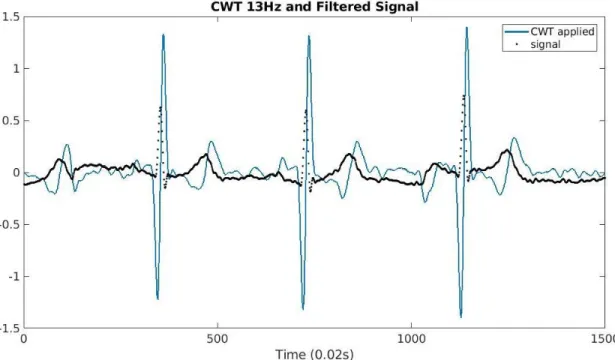 Figure 3.5 Amplified QRS 