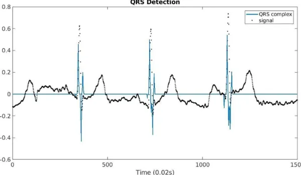 Figure 3.6 QRS identification result 
