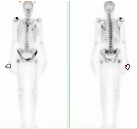 Figure 1. Bone scans image, anterior image left and posterior image right. 
