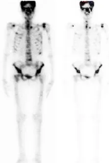 Figure 4. (a) Original bone scan image, (b) Image enhanced with HE, (c) Image enhanced with AHE
