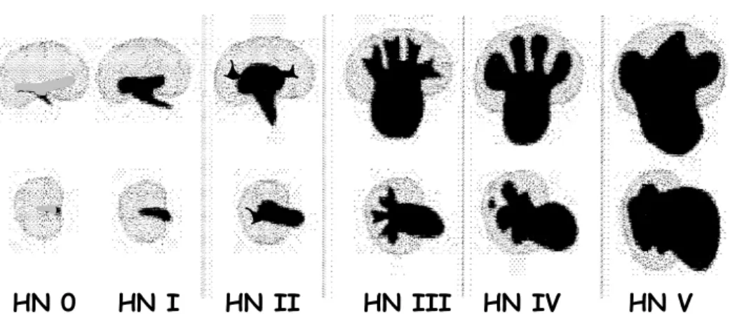 Table 1. Grading of Hydronephrosis (HN) 