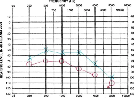 Figure 1.2: Example of a clinical air conduction threshold audiogram. Hearing thresholds in the right and left ears  are denoted by red O and blue X marks, respectively