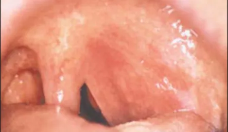 Figure 3. Left peritonsillar abscess. Notice the shift of the uvula to the right side and the redness of the left tonsillar pillars.