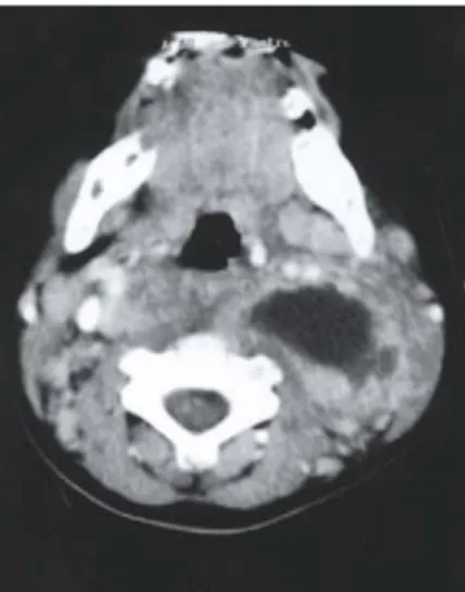 Figure 5. Left parapharyngeal abscess.