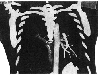 Fig. 3 CT scan demonstrates the herniated bowel in the right chest in patient 2.