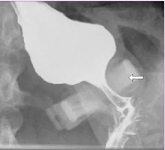 Figure 2. A view of the dilated esophagus and gastric band  (arrow).