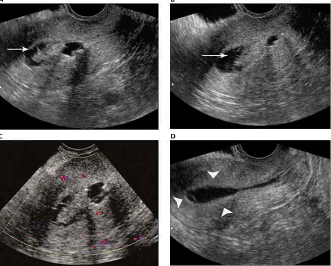 Figure 3. Blood clot mimicking a mass. The patient had postmenopausal bleeding. Initial images (A and B) show an echogenic mass in the endometrial cavity (arrow)